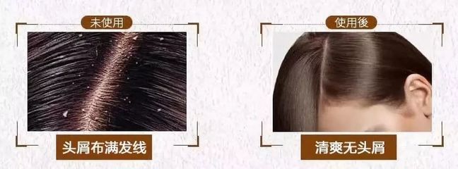 告別脫發、頭皮屑與頭發稀少的煩惱，重塑烏黑濃密的秀發